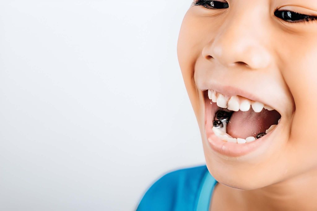 stainless steel crowns for kids in brandon fl