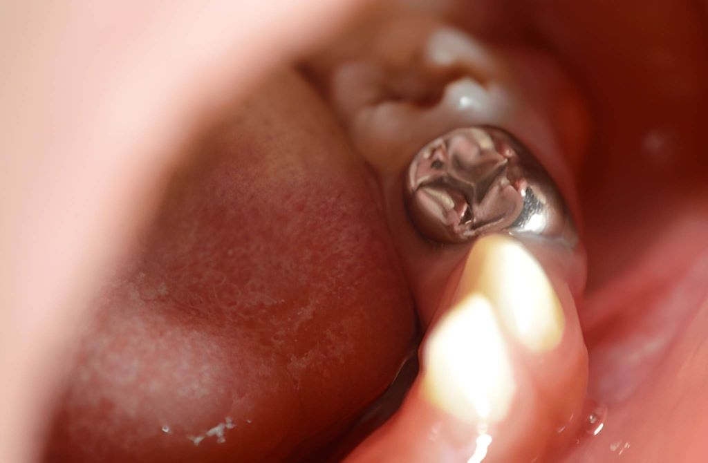 stainless steel crowns near you